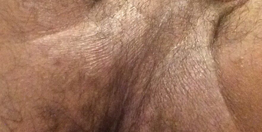 mycose sur testicule mycose sur testicule